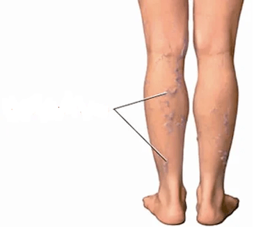 Consecințele osteoartritei genunchiului