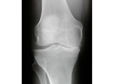 Diagnosticul artrozei articulației genunchiului