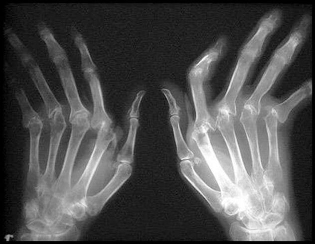 X -RAY Imaginea mâinilor afectate de osteoartrită