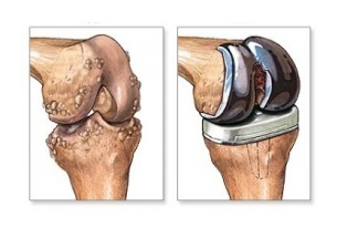 Inlocuirea genunchiului pentru osteoartrita