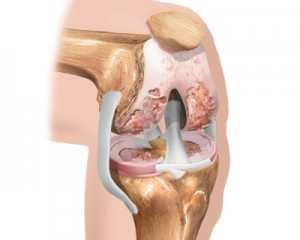 stadiul inițial al osteoartritei genunchiului