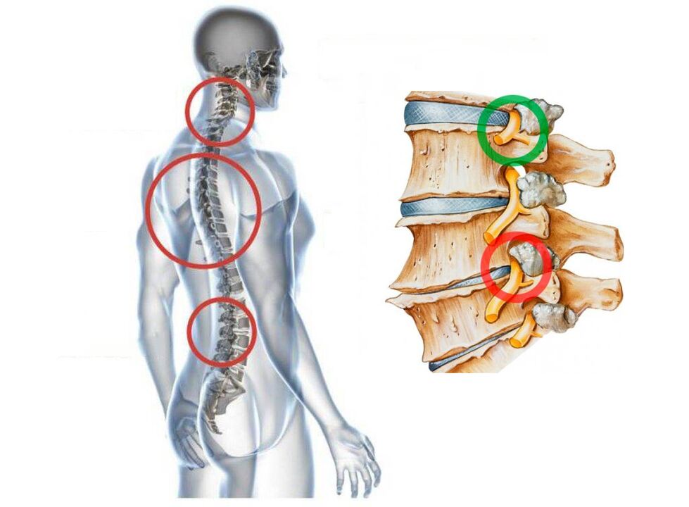Ce arată osteocondroza cervicală ca vertebrele