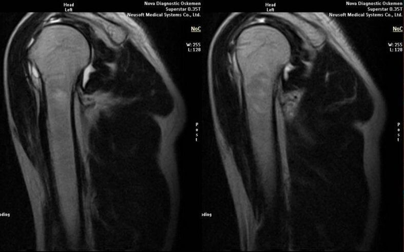 Osteoartrita articulației umărului pe radiografie