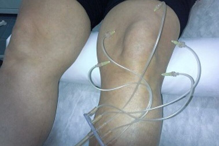 Terapia cu ozon