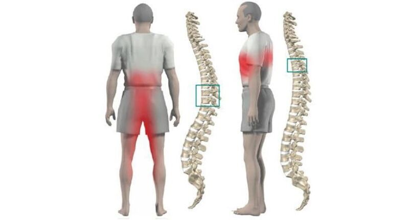 Dureri în corp și coloană vertebrală cu osteocondroză