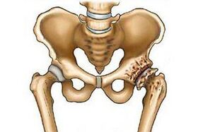 Distrugerea articulației șoldului în osteoartrită