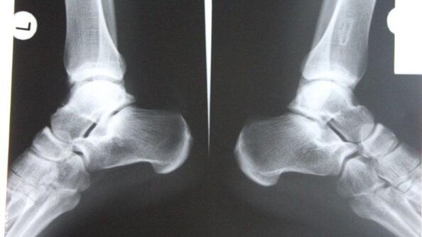 Diagnosticul osteoartritei gleznei folosind raze X