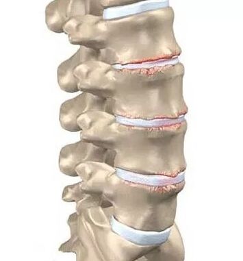 Osteochondroză